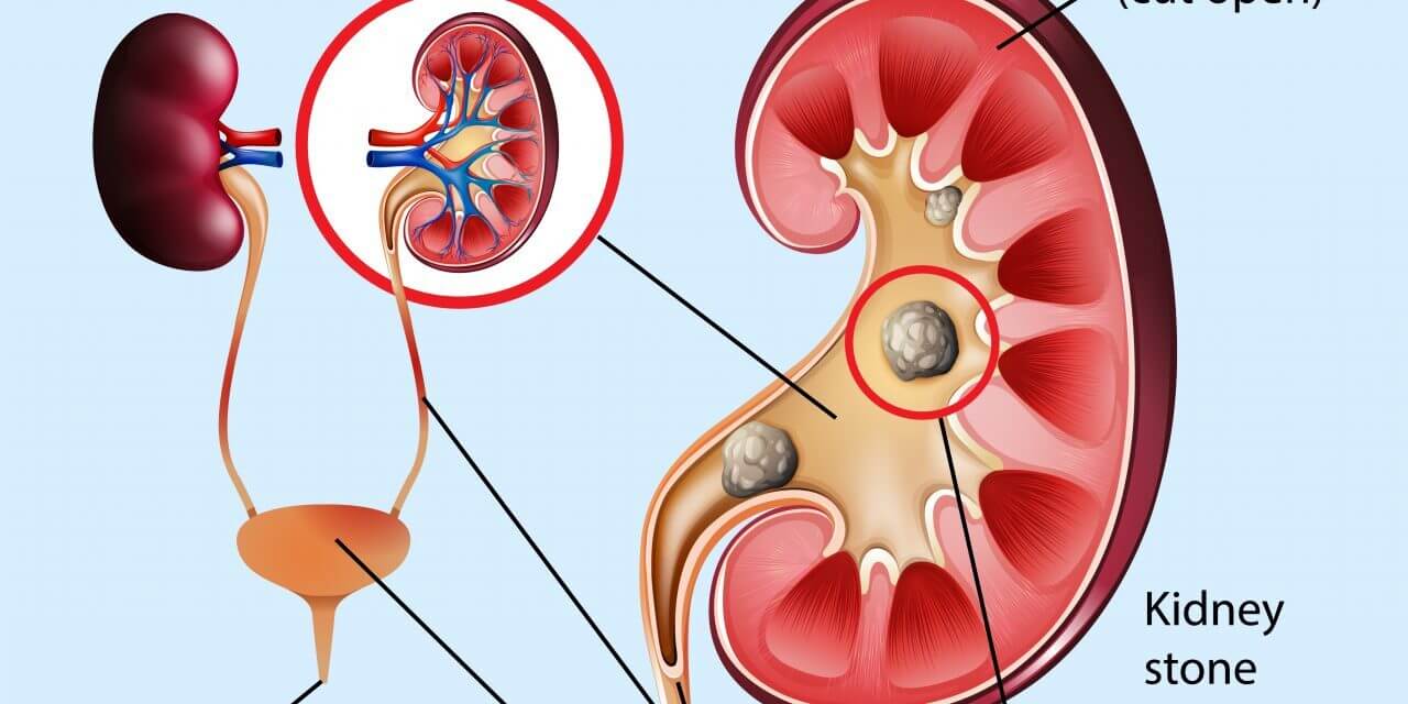 4 INITIAL SIGNS OF KIDNEY STONES YOU SHOULD LOOK FOR!